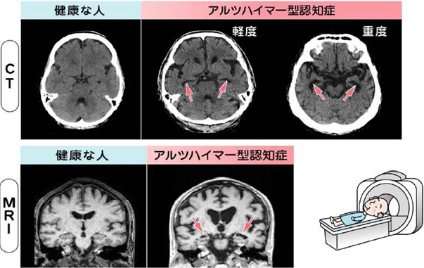 アルツハイマー型認知症　脳の変化