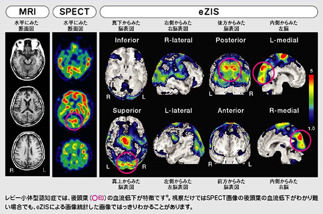 レビー小体型認知症 脳の変化