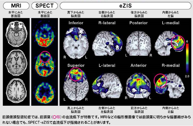 前頭側頭型認知症　脳の変化